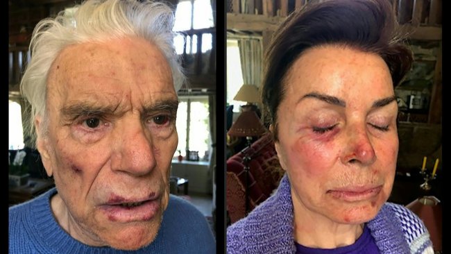 Bernard Tapie et son épouse victimes d'une violente agression