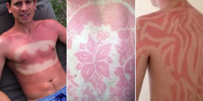 Le tatouage coup de soleil : la nouvelle folie qui amuse les internautes mais inqui&egrave;te les m&eacute;decins