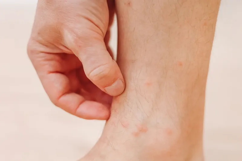 close up man scratching with hand allergic rash on leg leg with red rash caused by insect bites dermatitis, folliculitis, fungal infection affected area of red and blotchy and to swell skin