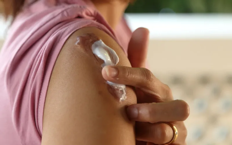 apply the cream to the keloids wound to make the wound soft