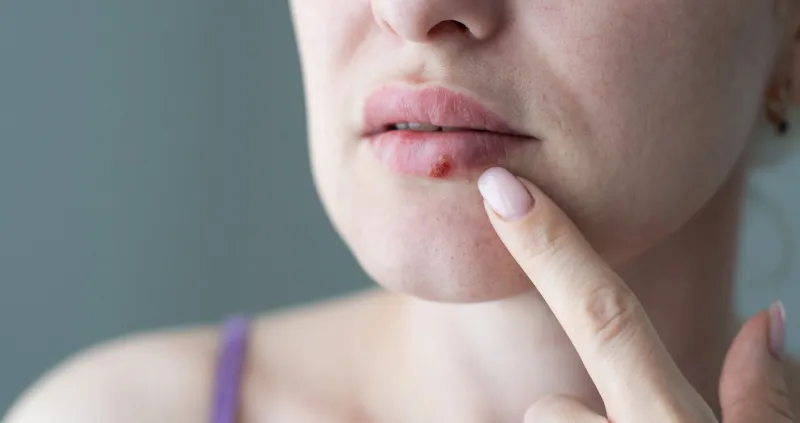 the woman with a virus herpes on lips