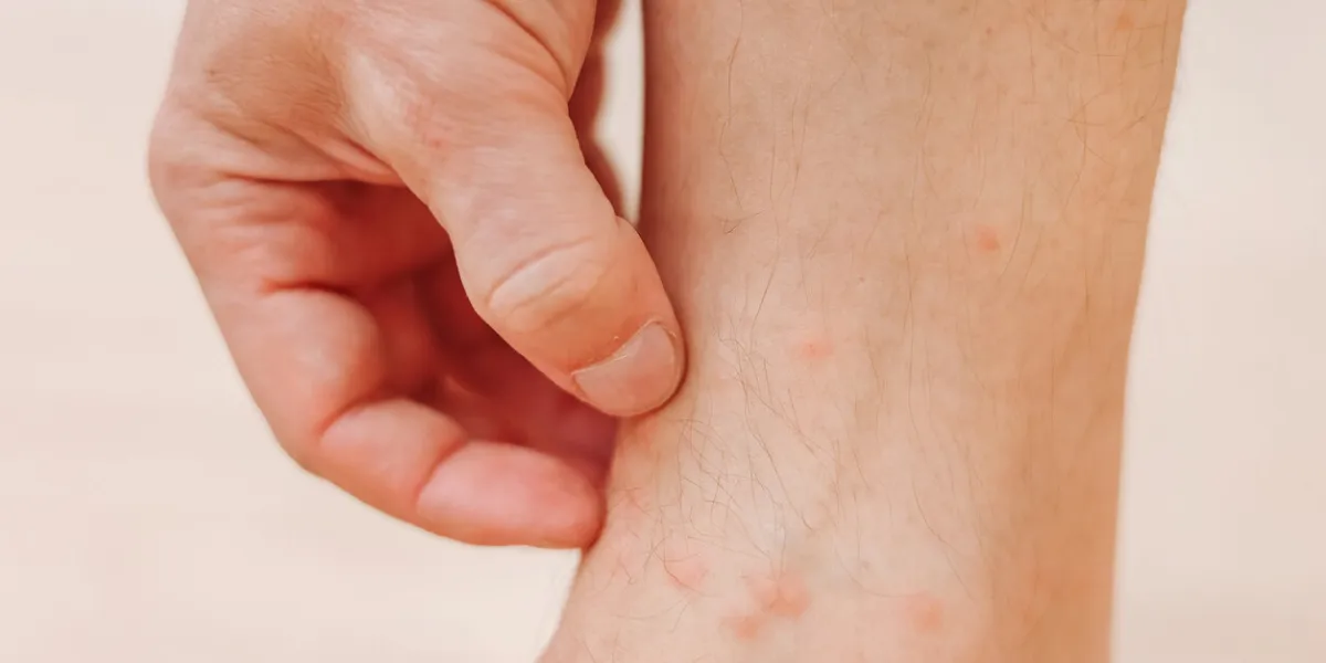 close up man scratching with hand allergic rash on leg leg with red rash caused by insect bites dermatitis, folliculitis, fungal infection affected area of red and blotchy and to swell skin