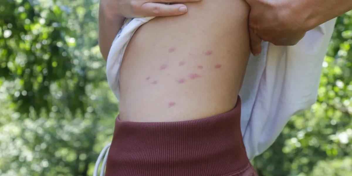 red, swollen and itchy spots on skin caused by insect bites or allergy skin reaction to insect bites