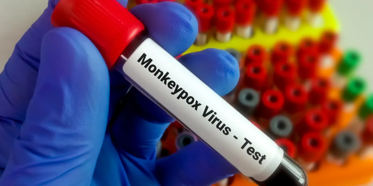 blood sample for monkeypox virus test it is also known as the moneypox virus, a double-stranded dna virus and member of poxviridae family